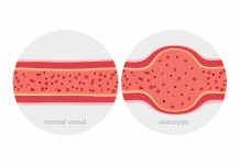 Ecco le cellule che indeboliscono le arterie cerebrali con rischio aneurisma